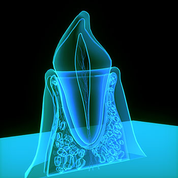 Alternativ till rotfyllningar